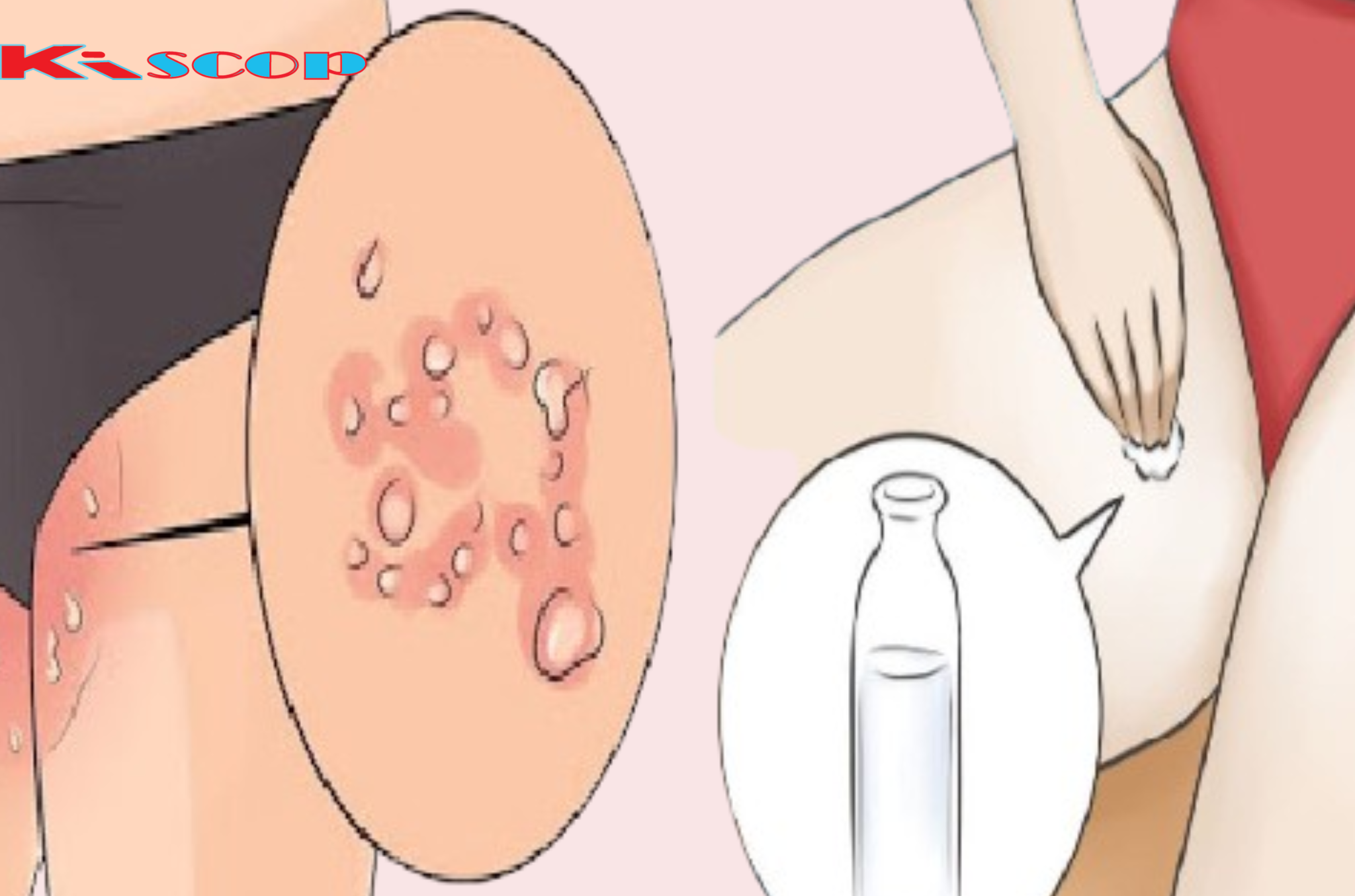 Reasons for Getting Skin Fungus and How to Prevent It