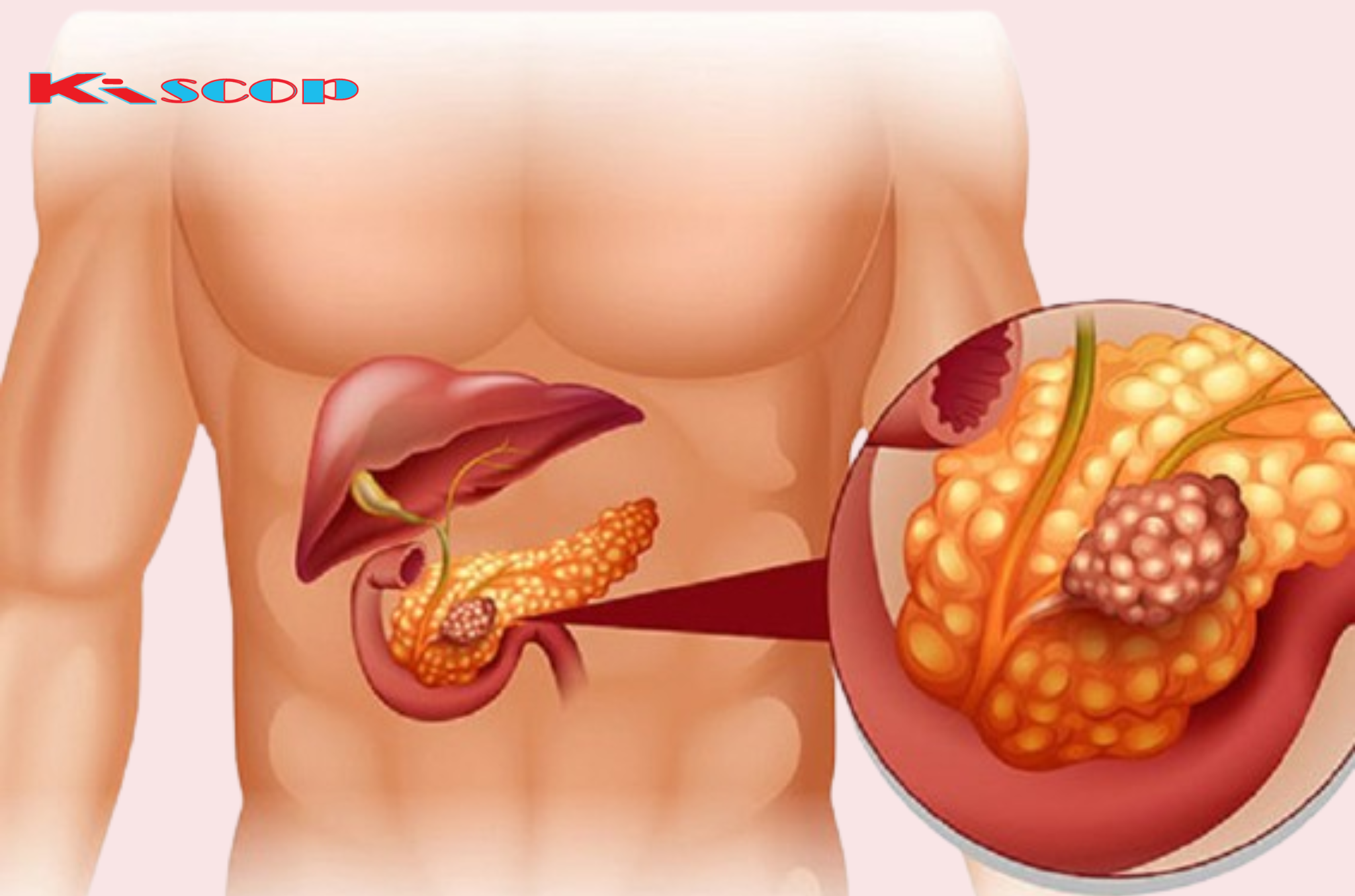 5 Warning Signs Your Pancreas Is in Trouble